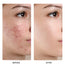 SKINEVER Salicylic Acid Deep Pore Cleansing Masque
