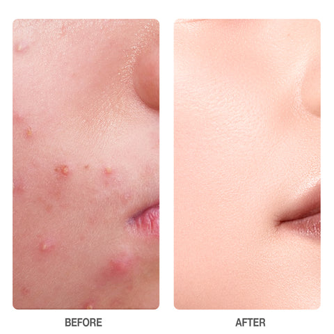 SKINEVER Salicylic Acid Acne Treatment Ice Sleep Masque