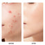 SKINEVER Salicylic Anti Acne Serum