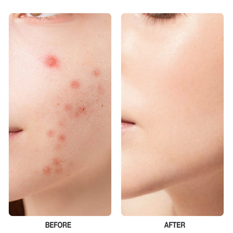 SKINEVER Salicylic Anti Acne Serum
